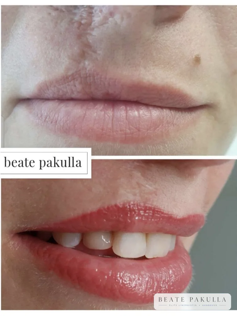 Lippenpigmentierung bei LTL Elite in Hannover – Beispiel 5